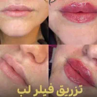 تزریق فیلر لب روسی|خدمات آرایشگری و زیبایی|تهران, ستارخان|دیوار