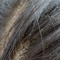 تمیز کردن شپش