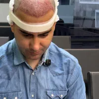 جشنواره نوروزی کاشت مو شرایط اقساطی و با ضمانت