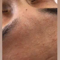 فیشیال و کربوکسی تراپی تخصصی پوست با تخفیفات ویژه|خدمات آرایشگری و زیبایی|قرچک, میرزائی شمالی|دیوار