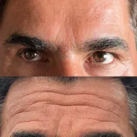 بوتاکس فقط امروز ۶۹۰ تومان توسط پزشک