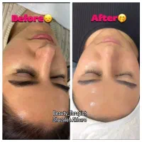 جوانسازی و پاکسازی پوست فقط۲۹۹ هایفو صورت و غبغب