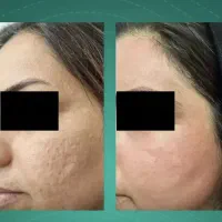 رفع لک و کک مک پوست صورت