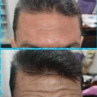 زیبایی لیفت بلفارو فرم بینی بوتاکس نخ ابروزاویه ژل|خدمات آرایشگری و زیبایی|اصفهان, خانه اصفهان|دیوار