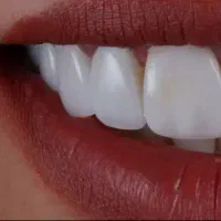 جشنواره کامپوزیت بدون تراش دندان فکی ۱۰میلیون