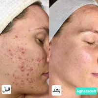 تزریق مزوژل روشن‌کننده جوانساز وبوتاکس|خدمات آرایشگری و زیبایی|آبادان, |دیوار