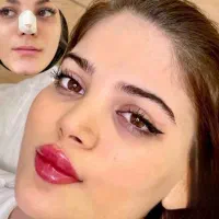 کانتورینگ لیفت فیلر بوتاکس مزو|خدمات آرایشگری و زیبایی|اصفهان, سپاهان‌شهر|دیوار