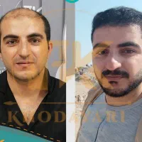 جشنواره عیدانه کاشت مو و ابرو  تخفیف ویژه