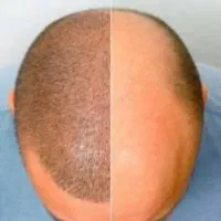 کاشت مو و ابرو با بهترین برندهای روز