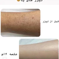 فیشال ولیزر مدیکا ژاندارمری|خدمات آرایشگری و زیبایی|اردبیل, |دیوار