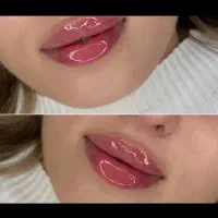 ژل وبوتاکس فقط ۴۳۰ با 1 ccژل بوتاکس هدیه بگیر
