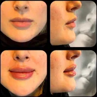 تزریق ژل و فیلر