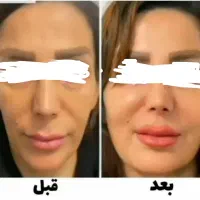 تپلی صورت و جوانسازی