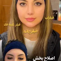 تزریق فیلر کل صورت با ۵۰٪ تخفیف