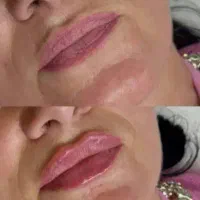 تخفیفات پاییزه   ژل ، بوتاکس ، فیلر،جوانسازی پوست|خدمات آرایشگری و زیبایی|تهران, نیروی هوایی (پیروزی)|دیوار