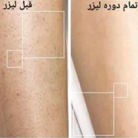 جشنواره لیزر حذف موهای زائد فول ۴۵۰|خدمات آرایشگری و زیبایی|ارومیه, |دیوار