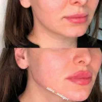 تزریق ژل فیلر تضمینی بوتاکس پرسینگ چاله گونه|خدمات آرایشگری و زیبایی|قم, نیروگاه|دیوار