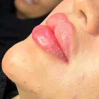 بوتاکس و ژل وفیلر فقط ۶۹۰تومن ترمیم رایگان