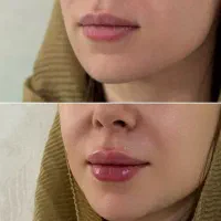 جشنواره تخفیف فیلرو بوتاکس و کامپوزیت