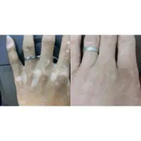 درمان پیسی (ویتیلیگو)