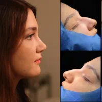 جراحی بینی،باروش نوین پیزو،تخفیف ۵۰درصد