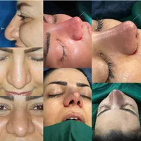 عمل جراحی بینی با تخفیف ویژه در فستیوال تابستانه|خدمات آرایشگری و زیبایی|تهران, فلسطین (میدان انقلاب)|دیوار