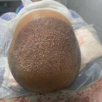 کاشت مو، PRP و مزوتراپی مو، بوتاکس