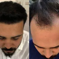 کاشت مو و ابرو تخصصی