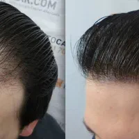 کاشت مو اقساطی اسکو