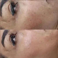 آموزش فیشال و پاکسازی تخصصی پوست مزونیدلینگ مزوایت|خدمات آرایشگری و زیبایی|مشهد, احمدآباد|دیوار