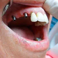 مرکزفوق تخصصی ایمپلنت دیجیتال مشهد/سبک کاخ لبخند