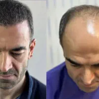 کاشت موی طبیعی با ضمانت