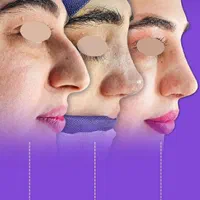 رینوپلاستی / جراحی بینی / اقساط