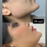 جشنواره ویژه فیلر لب فول فیس زاویه فک،گونه،چونه و.|خدمات آرایشگری و زیبایی|مشهد, شهید فرامرز عباسی|دیوار