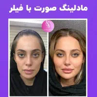 مطب تزریق ژل لب تخفیف لیزر فیلر لیفت صورت بوتاکس