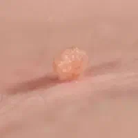 خدمات پلکسر از بین بردن خال وزیگیل|خدمات آرایشگری و زیبایی|پاکدشت, پاکدشت (مامازند)|دیوار