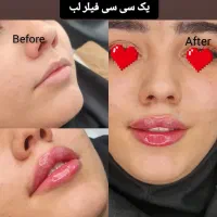 جشنواره عیدانه ترریق فیلر پزشک متخصص+مشاوره رایگان