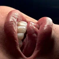 کامپوزیت دندان هرفک۲۰م روش لیرینگ