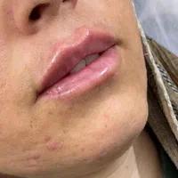 ژل لب متود روسی توسط پزشک حرفه ای