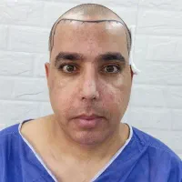 کاشت مو طبیعی به روش سوپر میکروگرفت|خدمات آرایشگری و زیبایی|اهواز, کیانپارس |دیوار