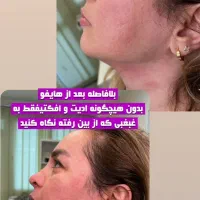 هایفوتراپی/هایفو/جوانسازی/لیفت صورت/ رفع غبغب