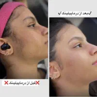 درماپلینگ و پاکسازی