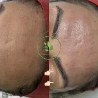 فیشال کامل ۳۸۰ (پاکسازی پوست) حرفه ای به مدت محدود