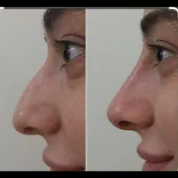طراحی لیفت بینی وفرمدهی عملی(بدون جراحی)پزشک متخصص|خدمات آرایشگری و زیبایی|مشهد, سناباد|دیوار