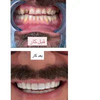 کامپوزیت ونیر آلمانی