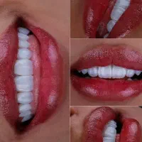 اقساط بدون چک / لمینت ایمپلنت کامپوزیت دندانپزشکی|خدمات زیبایی و سلامت|مشهد, کوثر|دیوار