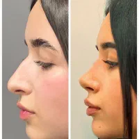 بزگترین هدیه عمل بینی در شیراز 100+میلیون|خدمات آرایشگری و زیبایی|شیراز, ستارخان|دیوار