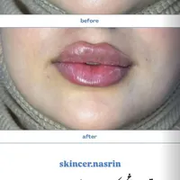 ورکشاپ اقتصادی مزوژل .مزوتراپی . بوتاکس|خدمات آموزشی|اصفهان, آبشار|دیوار