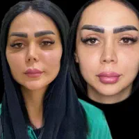 حجم دهی و کانتور صورت / با چربیِ گرفته شده از بدن