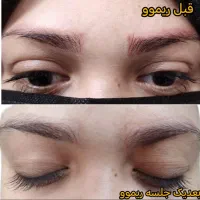 ریموو تتو قدیمی/قیمت مناسب، ویژه نموکار